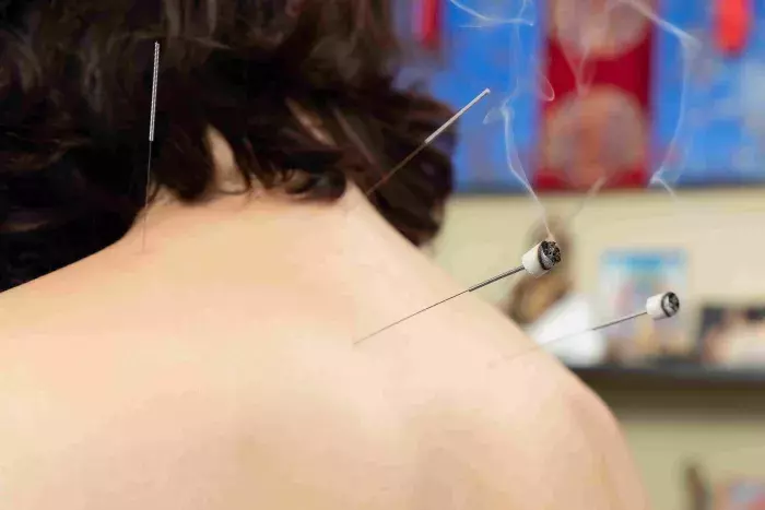 Acupuncture pour arrêter de fumer 